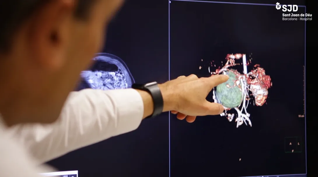 La planificación 3D permite extirpar con éxito un feto no desarrollado dentro de un bebé La planificación 3D permite extirpar con éxito un feto no desarrollado dentro de un bebé