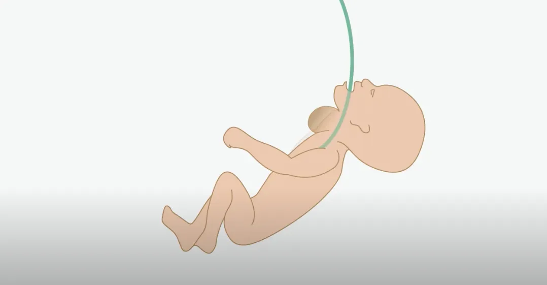 Vídeo explicatiu de les cirurgies fetals de tumors de cara i coll de BCNatal Vídeo explicatiu de les cirurgies fetals de tumors de cara i coll de BCNatal