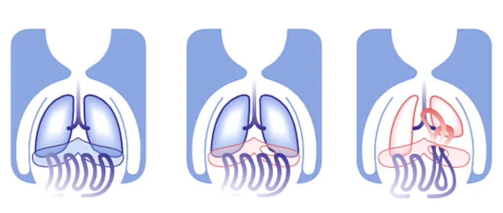 Esquema de la hernia diafragmática congénita (HDC) Esquema de la hernia diafragmática congénita (HDC)