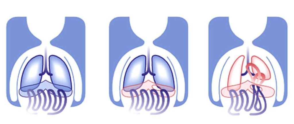 Esquema de la hernia diafragmática congénita (HDC)