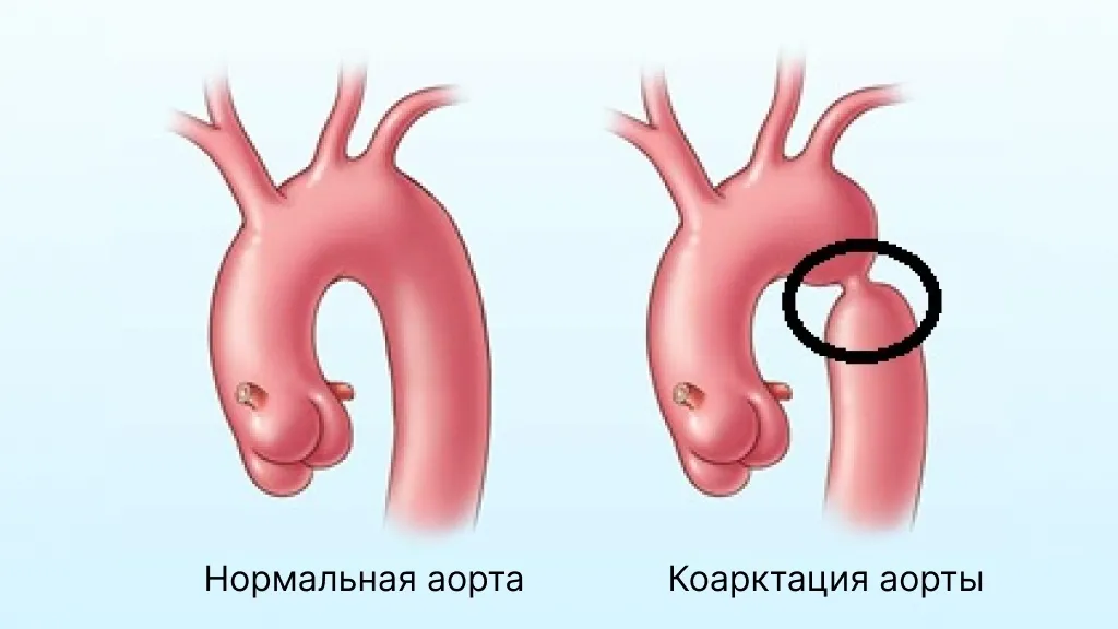 Что такое коарктация аорты