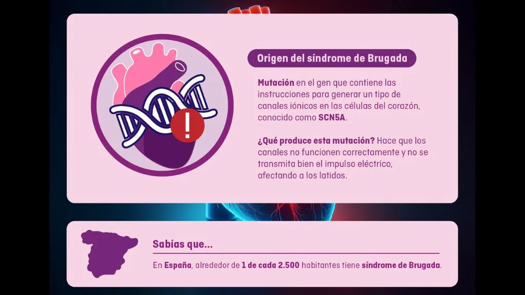 el síndrome de Brugada
