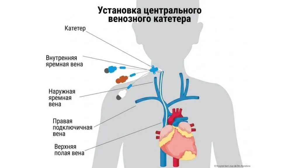 Установка центрального венозного катетера у детей