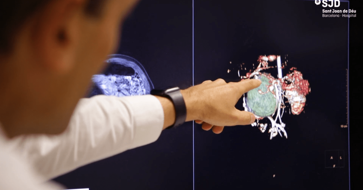 La planificación 3D permite extirpar con éxito un feto no desarrollado dentro de un bebé La planificación 3D permite extirpar con éxito un feto no desarrollado dentro de un bebé