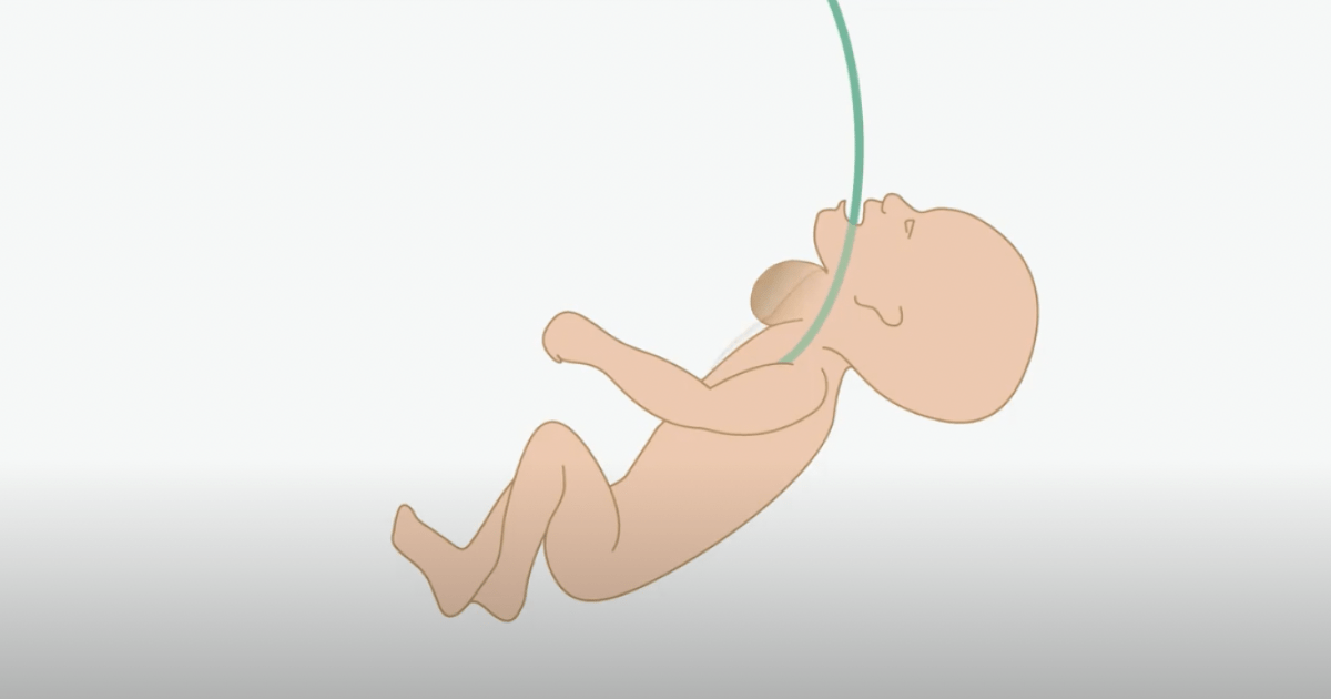 Explanatory video of BCNatal fetal surgeries for face and neck tumors Explanatory video of BCNatal fetal surgeries for face and neck tumors