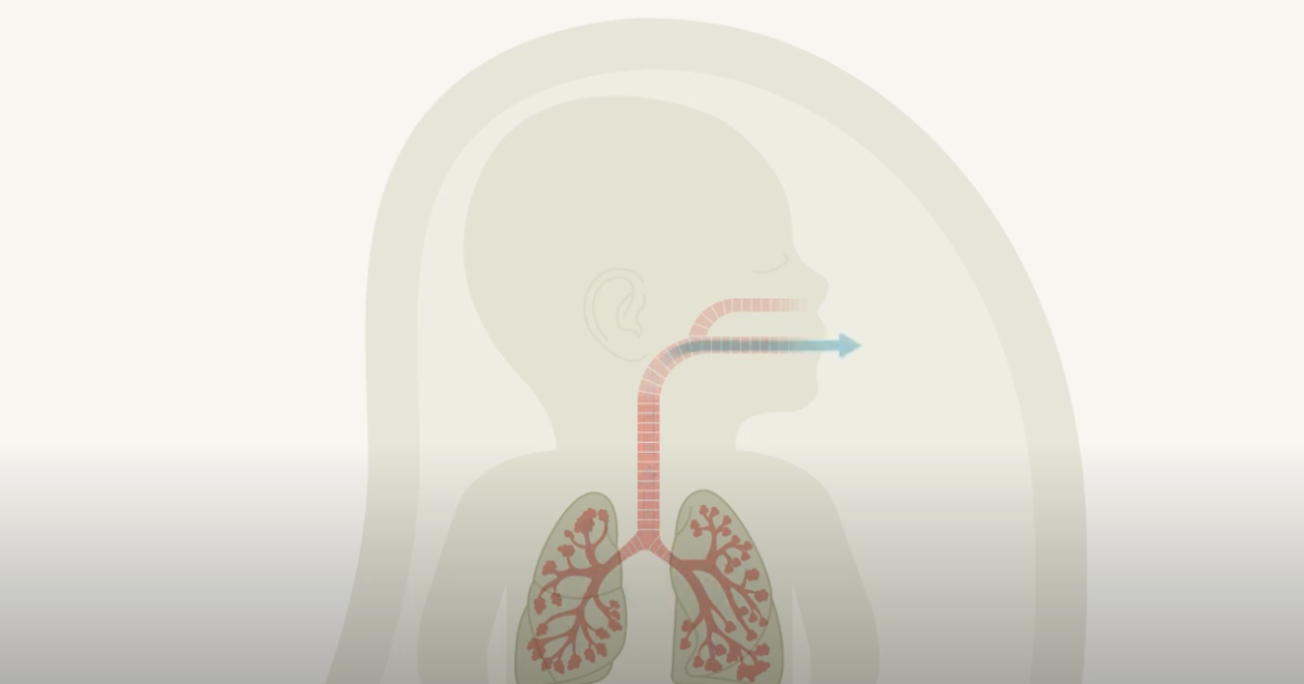 Vídeo explicatiu de les cirurgies fetals de tumors de cara i coll de BCNatal