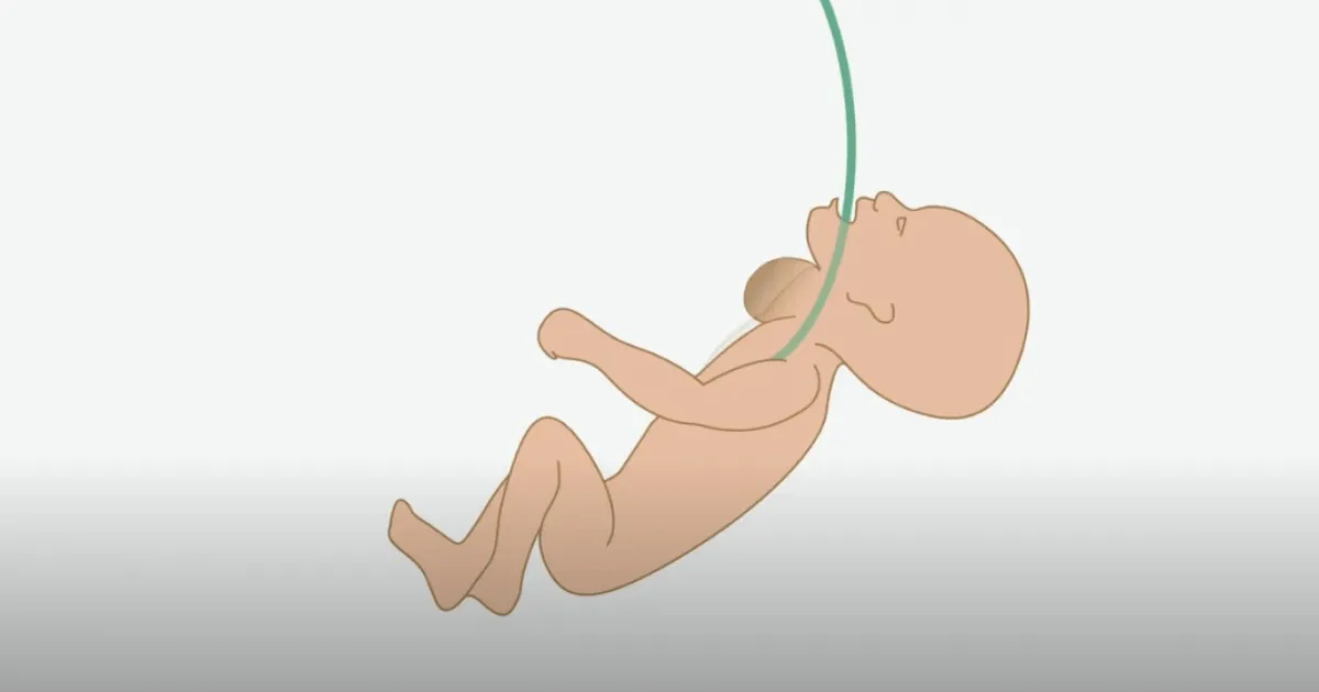 Vídeo explicativo de las cirugías fetales de tumores de cara y cuello de BCNatal Vídeo explicativo de las cirugías fetales de tumores de cara y cuello de BCNatal