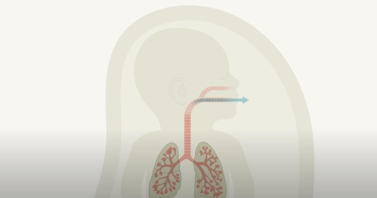 Explanatory video of BCNatal fetal surgeries for CHAOS syndrome