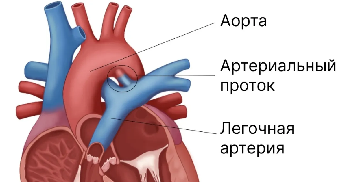 Открытый артериальный проток у новорожденных: что нужно знать родителям