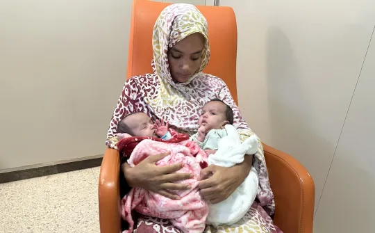 Conjoined twins separated at the SJD Barcelona Children's Hospital