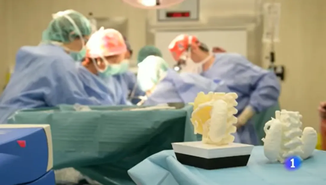 Impresión 3D aplicada a la extirpación de un tumor Impresión 3D aplicada a la extirpación de un tumor