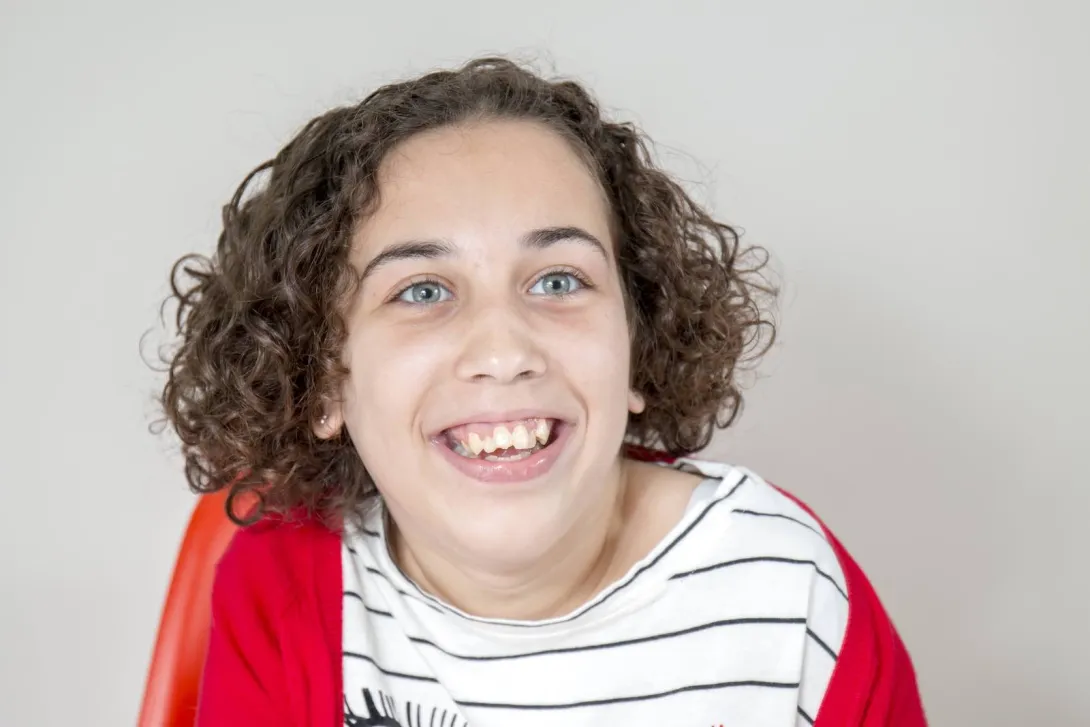 Niña con síndrome de Rett Niña con síndrome de Rett