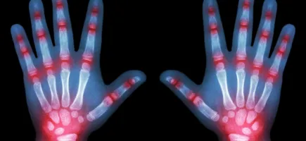 Master's Degree in Paediatric Rheumatology Master's Degree in Paediatric Rheumatology